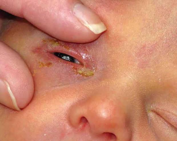 Konjungtivitis pada Anak: Penyebab, Gejala, dan Penanganan yang Efektif