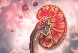 Batu Ginjal: Penyebab, Gejala, Pengobatan, dan Cara Mencegahnya Secara Alami