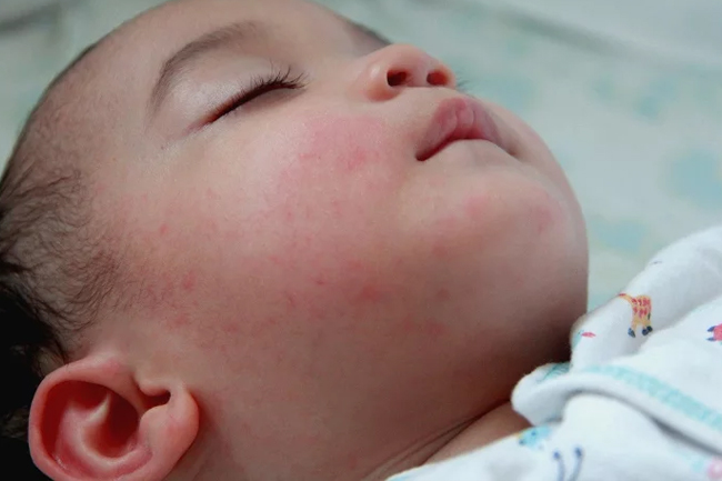 Waspada Campak! Penyakit Lama yang Masih Mengancam